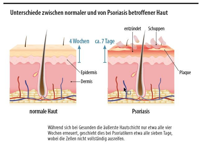 Psoriasis Grafik