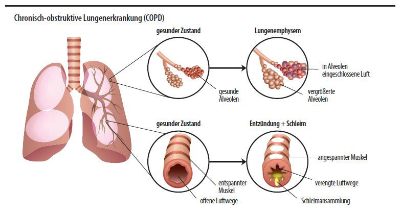 Grafik COPD