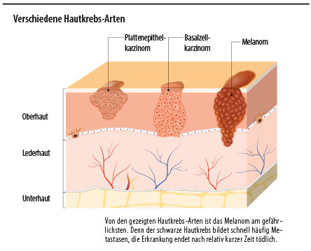 Grafik: Hautkrebsarten