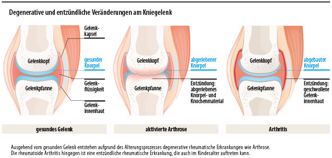 Degenerative und entzündliche Veränderungen am Kniegelenk
