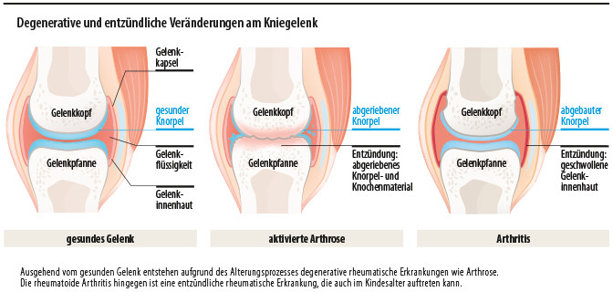 Degenerative und entzündliche Veränderungen am Kniegelenk
