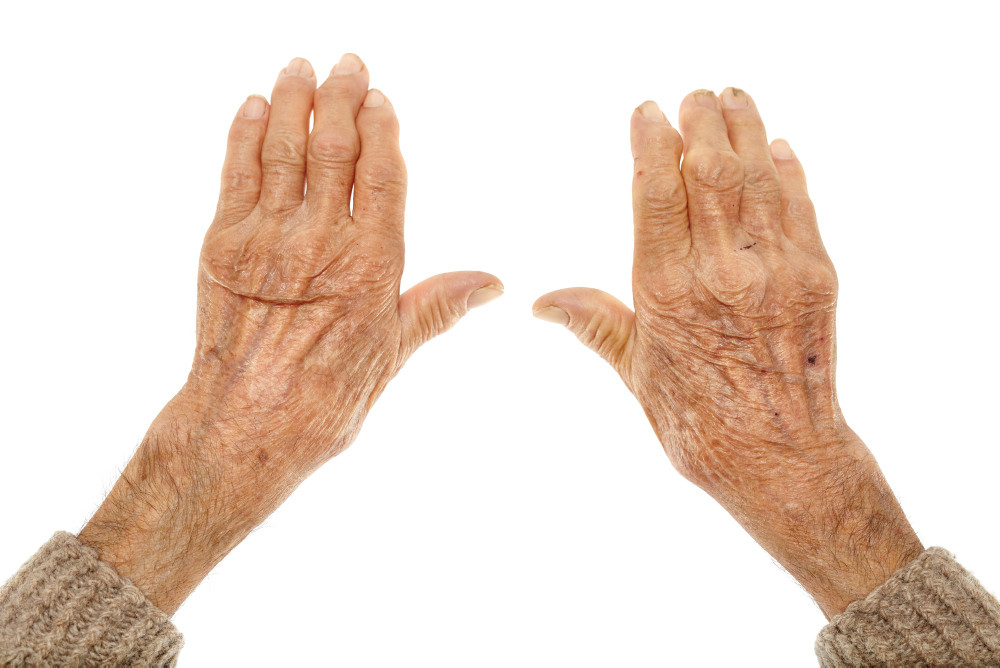 Durch rheumatoide Arthritis deformierte Hände