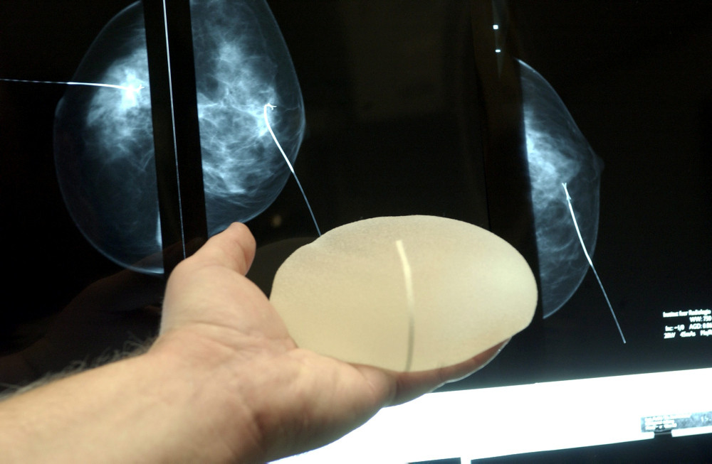 Männerhand, die ein Brustimplantat vor eine Röntgenaufnahme der Brust hält. Männerhand, die ein Brustimplantat vor eine Röntgenaufnahme der Brust hält.