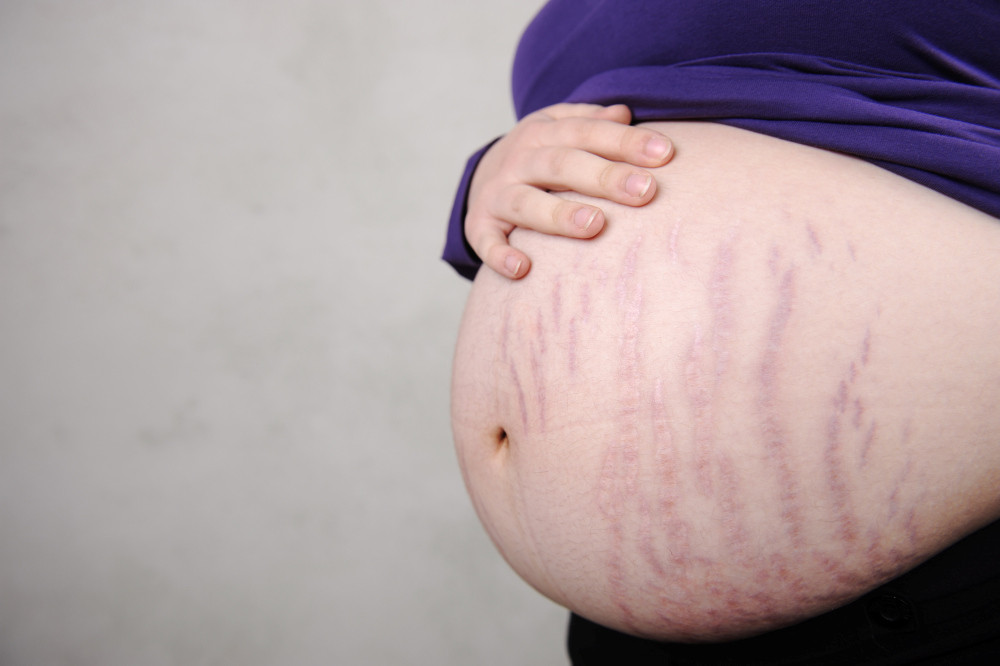 Bauch einer Schwangeren mit Dehnungsstreifen