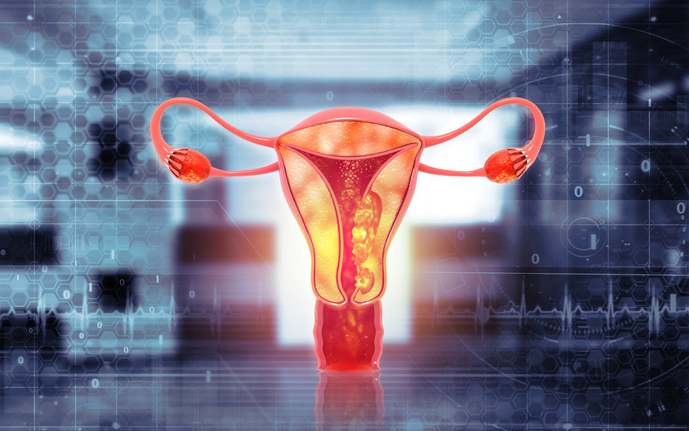3D-Modell Endometriumkarzinom