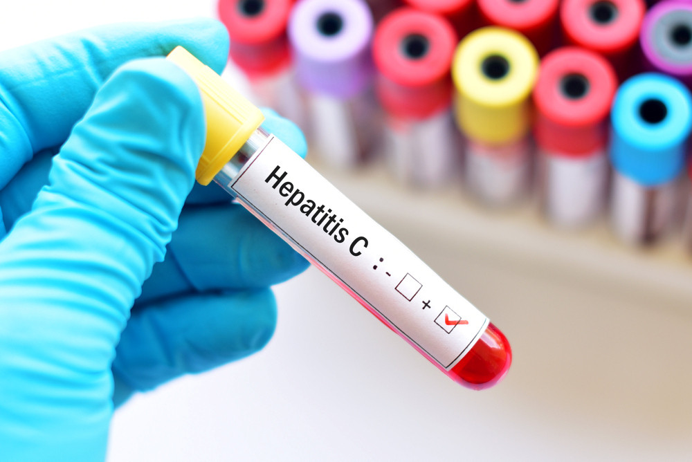 Hand mit blauem Handschuh, die ein Untersuchungsröhrchen mit der Aufschrift Hepatitis C hält. Hand mit blauem Handschuh, die ein Untersuchungsröhrchen mit der Aufschrift Hepatitis C hält.