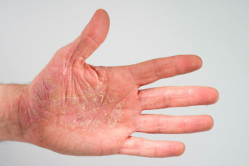 linke Hand mit Neurodermitis
