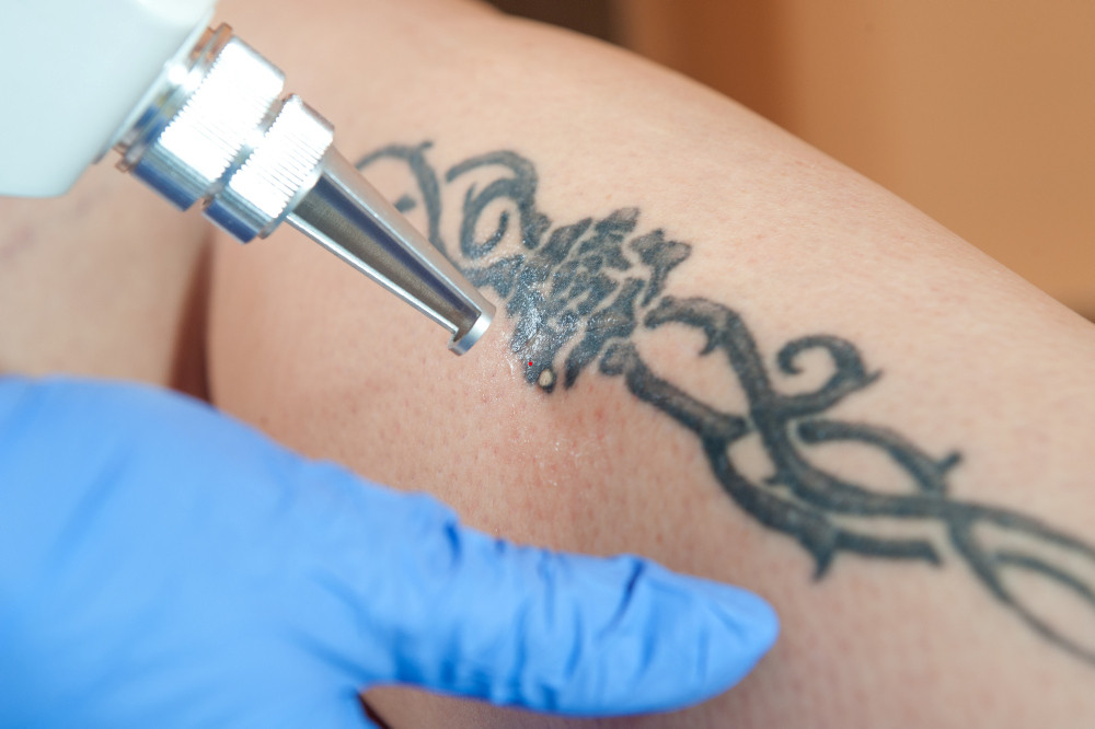 Tattooentfernung am Bein