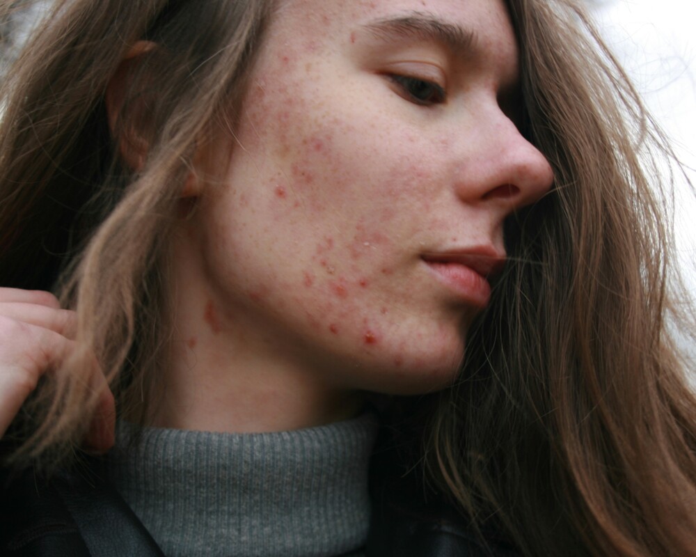 Jugendlicher mit starker Akne im Gesicht