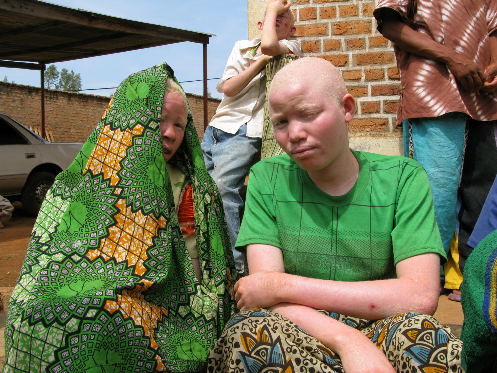 Zwei afrikanische Frauen mit Albinismus