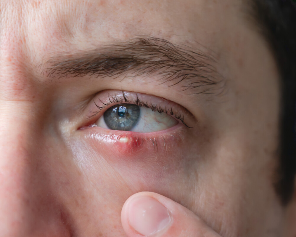 Mann mit infiziertem Chalazion (Gerstenkorn, Gerste) Auge am unteren Augenlid