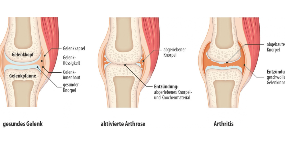 Grafik: Pathologische Veränderungen bei Arthrose und Arthritis