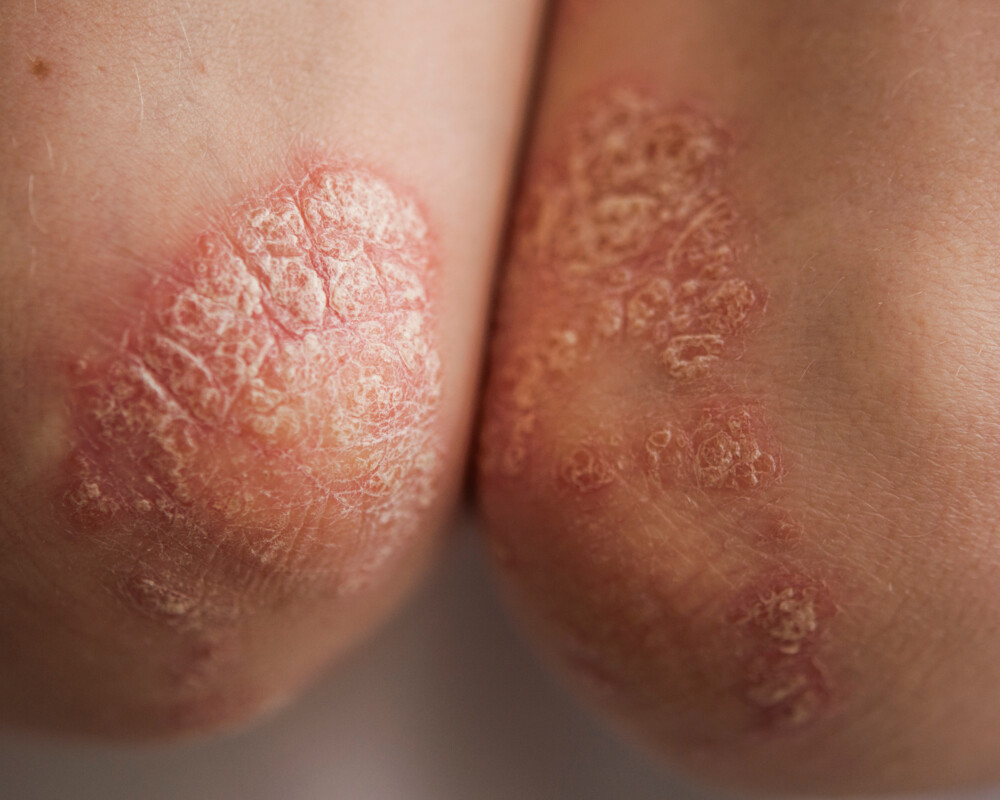 Psoriasis