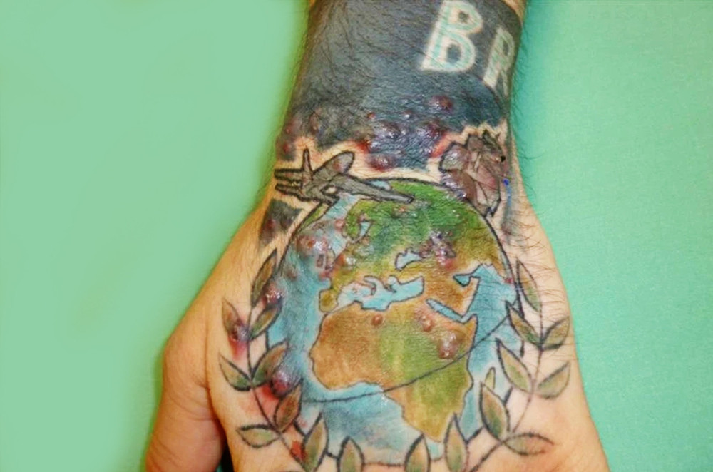 Hand mit buntem Tattoo und erythematöse Papeln und Pusteln