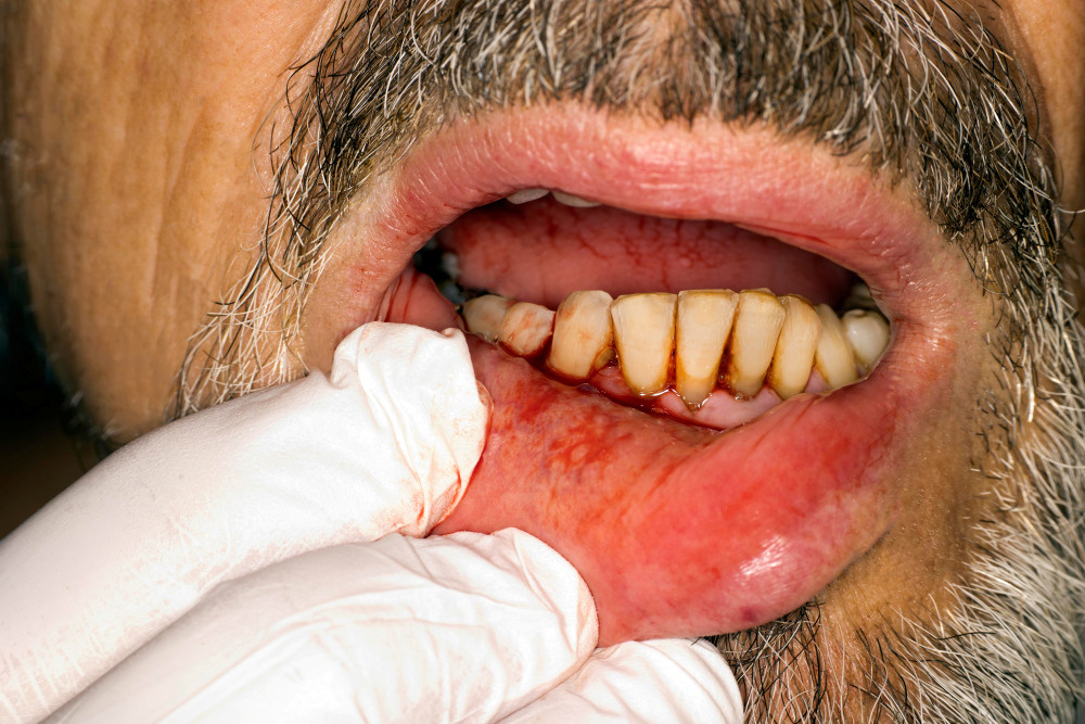 Mann mit Bart zeigt Zähne und stark blutendes Zahnfleisch