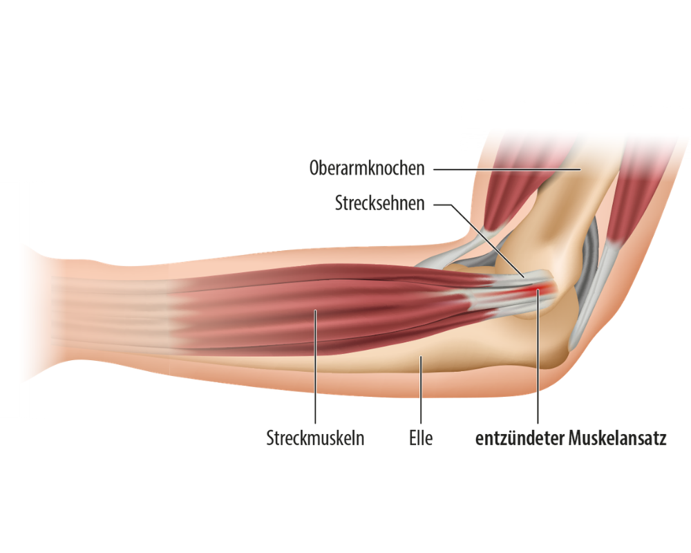 Grafik: Tennisarm
