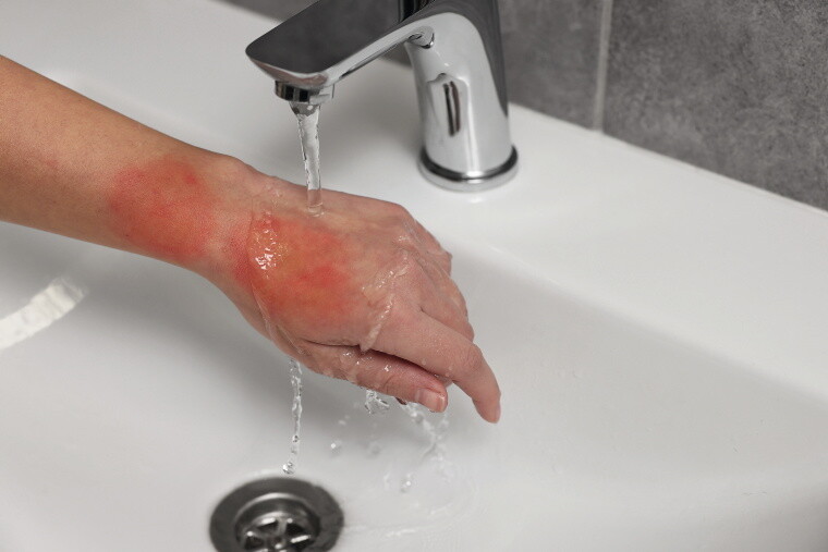 Verbrühte Hand wird mit Leitugnswasser gekühlt. Verbrühte Hand wird mit Leitugnswasser gekühlt.