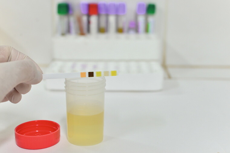 Urinprobe und pH-Test Urinprobe und pH-Test