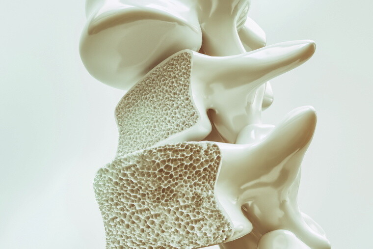 Knochen mit Osteoporose