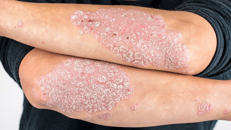 Psoriasis an den Armen