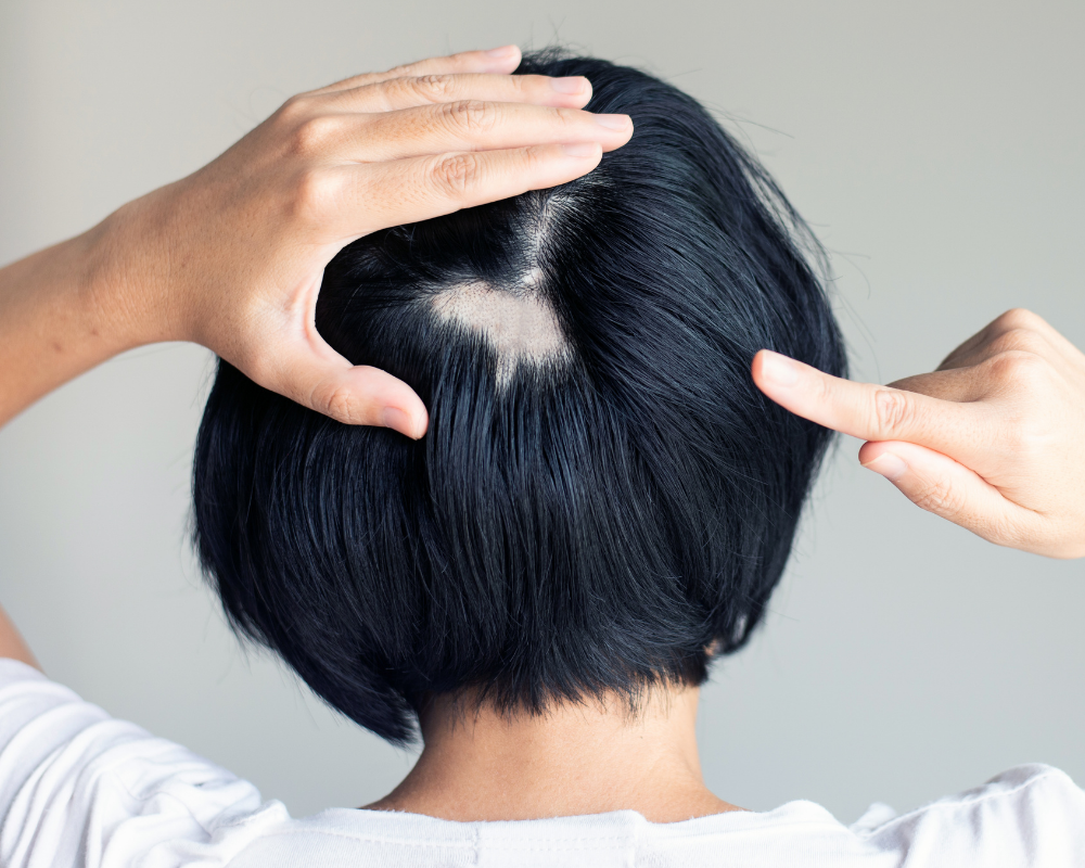 Hinterkopf einer Frau mit Haarausfall