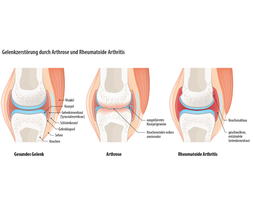 Grafik: Gelenkzerstörung durch Arthrose und Rheumatoide Arthritis Grafik: Gelenkzerstörung durch Arthrose und Rheumatoide Arthritis