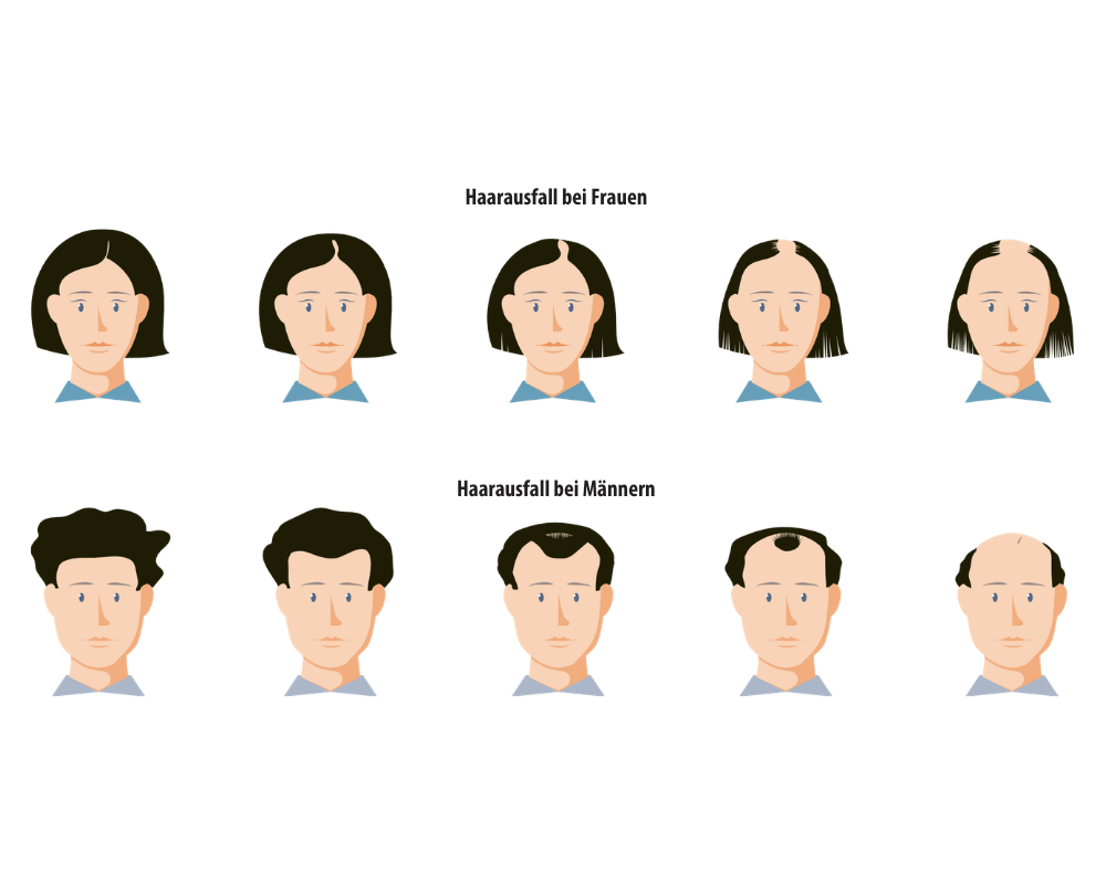 Grafik: Androgenetische Alopezie