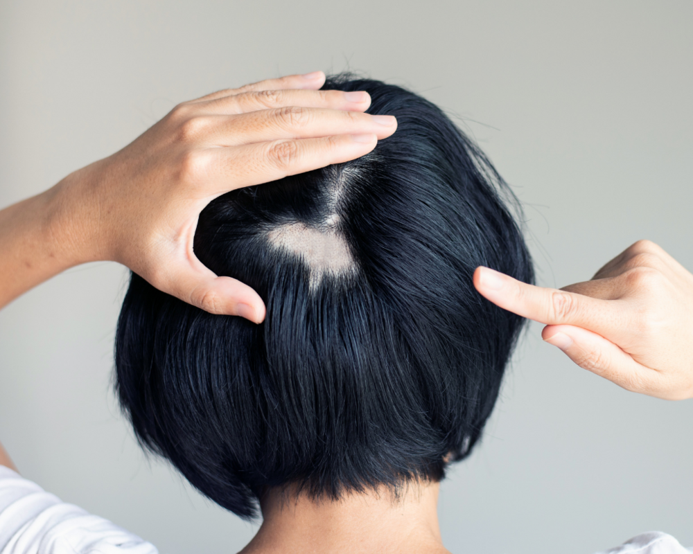 Hinterkopf einer Frau mit Haarausfall
