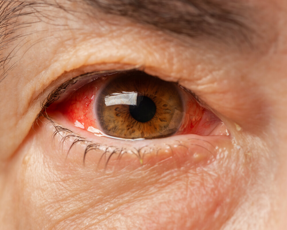 Rotes Auge