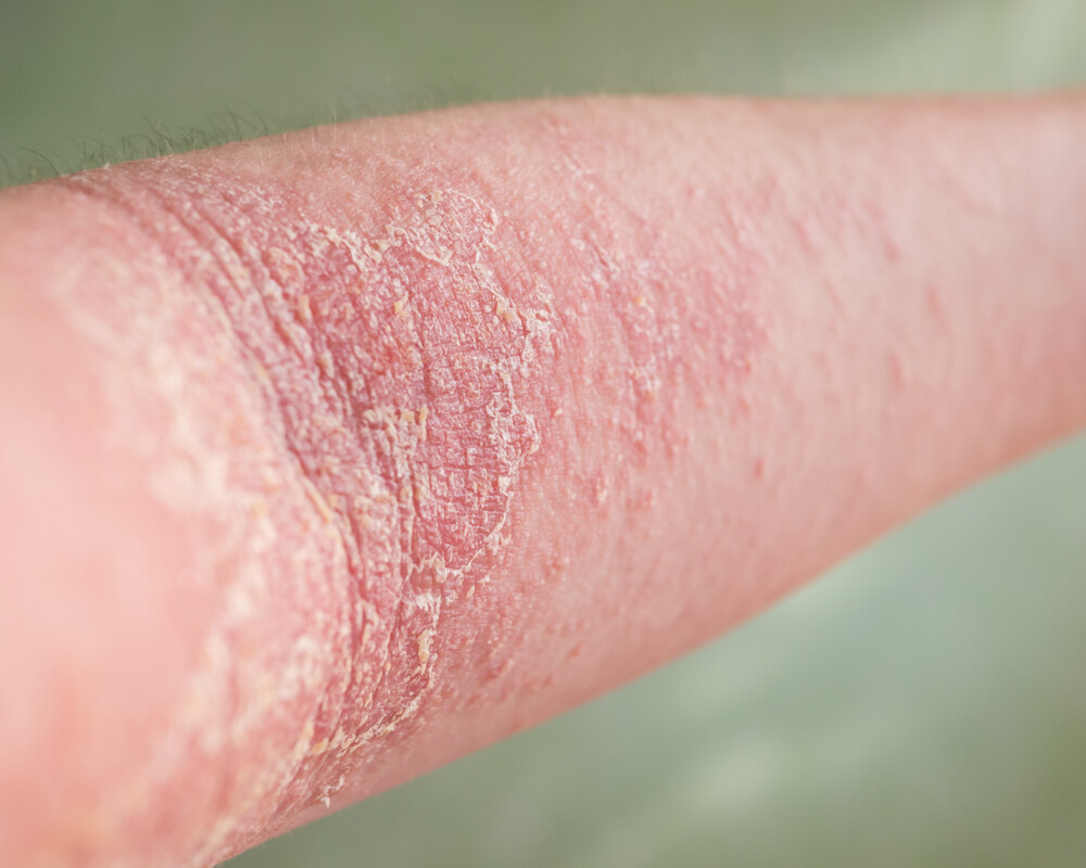 Dermatose