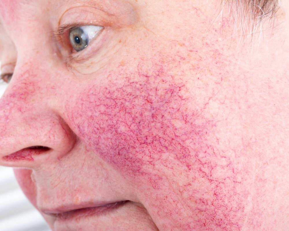 Rosacea