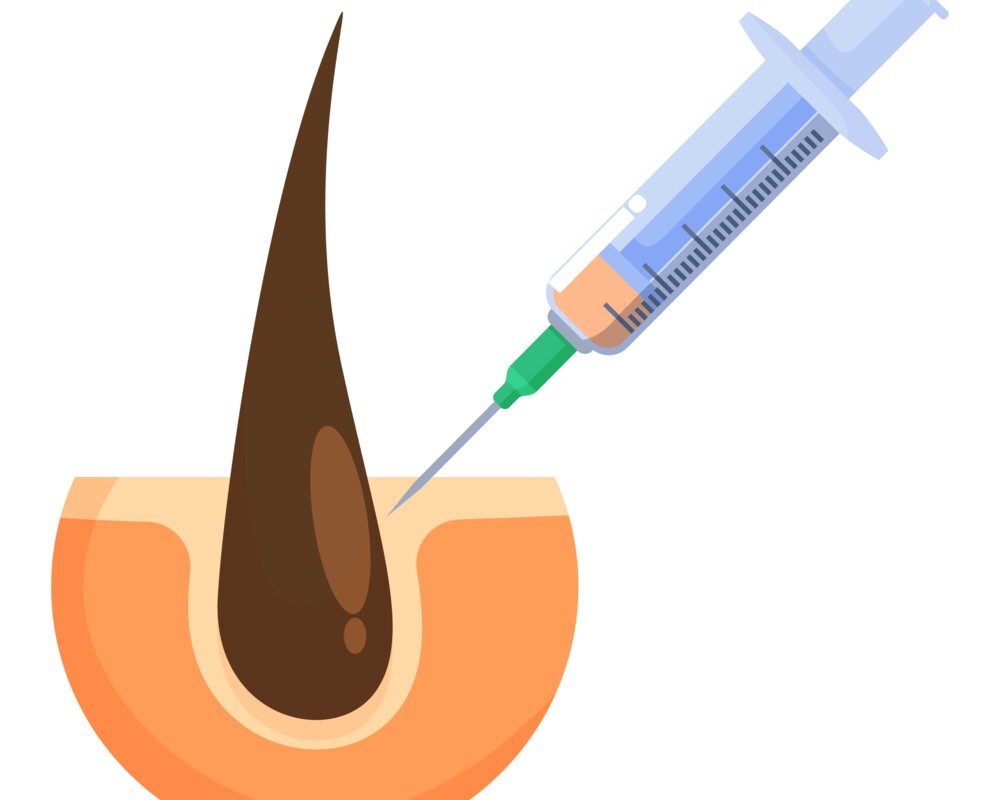Illustration: Spritze und Haarwurzel