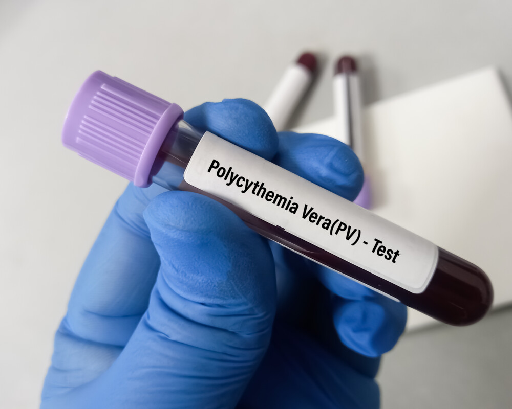 Labor-Reagentzglas mit Blut, beschriftet mit Polycythaemia vera