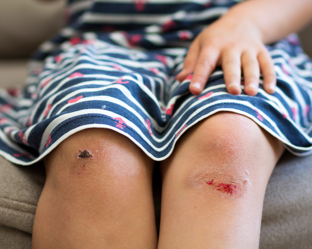 Wunde am Knie
