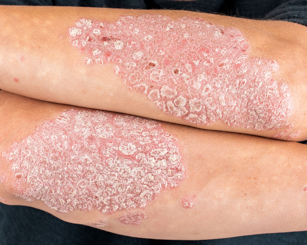 Psoriasis an den Armen