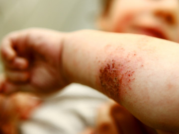 km_atopische Dermatitis_1216