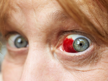 Frau mit Hämatom im Auge