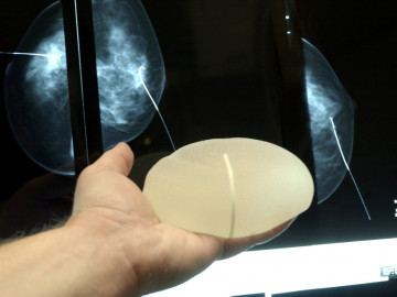 Männerhand, die ein Brustimplantat vor eine Röntgenaufnahme der Brust hält.
