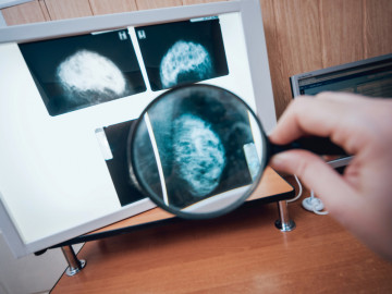 Mammographieaufnahme der weiblichen Brust unter der Lupe