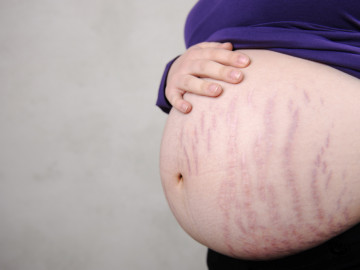 Bauch einer Schwangeren mit Dehnungsstreifen