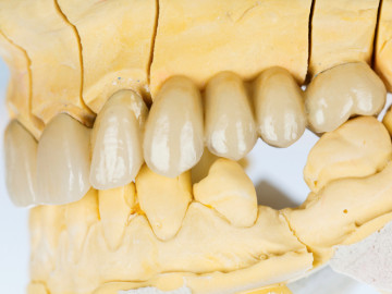 Gebissmodell mit Zahnlücke
