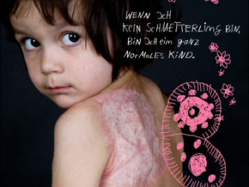 Aktionsbild zum Tag der Brandverletzung: Mädchen mit Verbrennung an linkem Schulterblatt und gezeichneten Schmetterlingsflügeln
