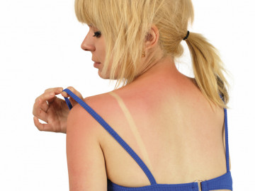 Frau mit Sonnenbrand auf Rücken und Schultern