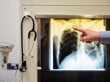 Röntgenaufnahme eines Tuberkulosepatienten