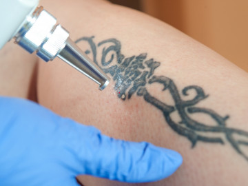 Tattoo am Arm wird weggelasert