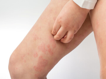 Kind mit atopischer Dermatitis kratzt sich am Oberschenkel