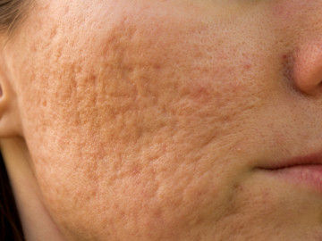 Hautausschnitt mit Aknenarben