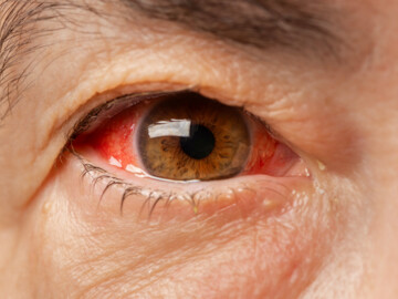 Rot geädertes Auge in Nahaufnahme