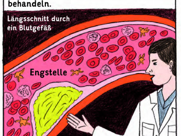 Darstellung einer Gefäßengstelle als Comic