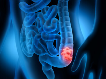 Illustration des Darms mit rotem Darmpolyp